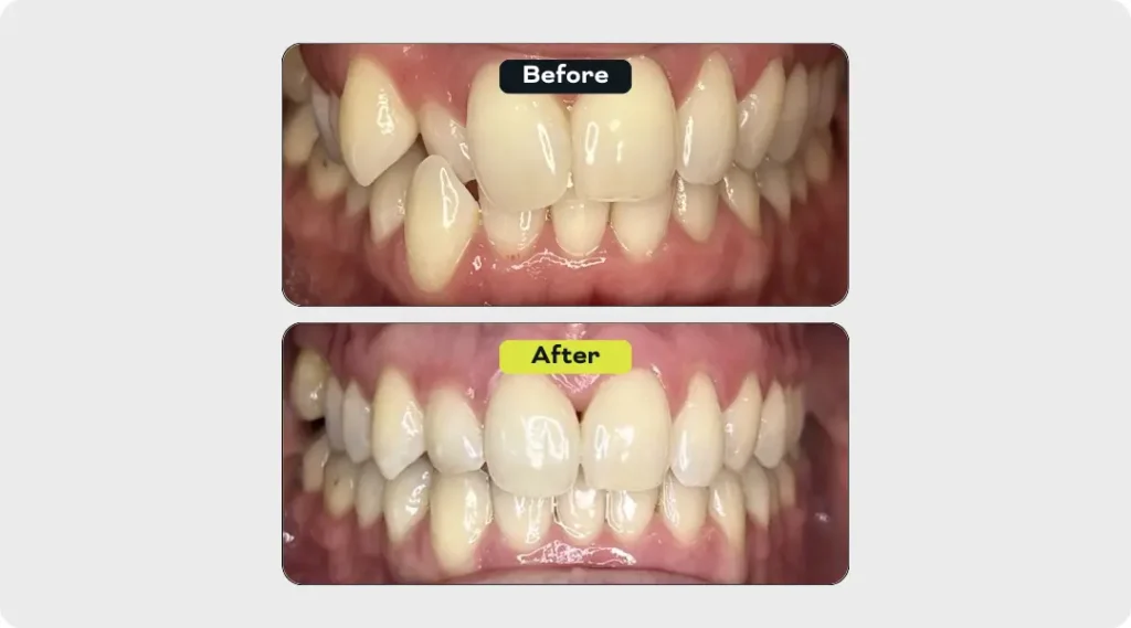 Before and after clear aligner treatment to correct an anterior crossbite at Urban Smile