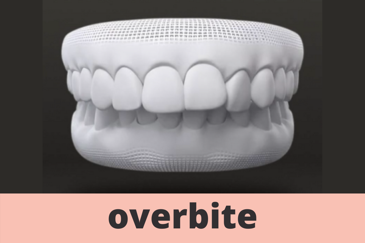 overbite smile