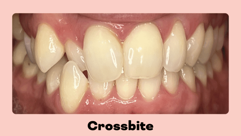 Close up of a crossbite before clear aligner treatment