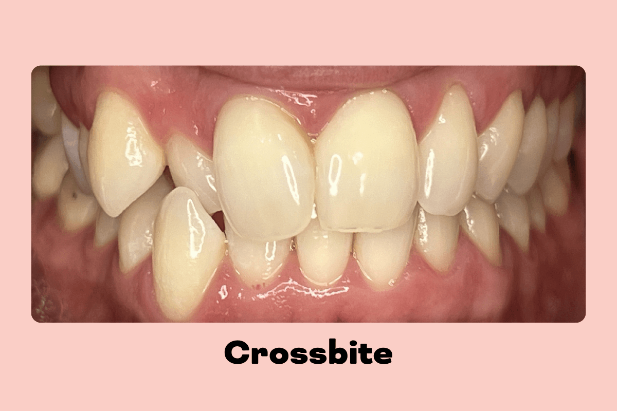 Close up of a crossbite before clear aligner treatment