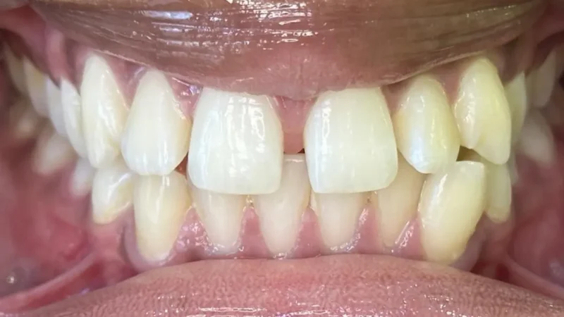 A close up of crowded teeth with a snaggletooth