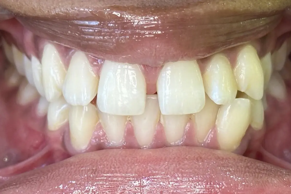 A close up of crowded teeth with a snaggletooth