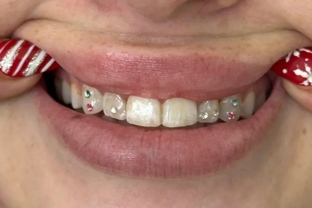 Smile with rose, aquamarine and crystal tooth gems applied by Urban Smile